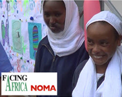 Intersurgical Charity supporting Facing Africa NOMA