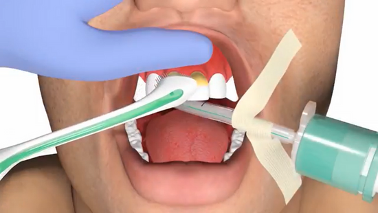 Effective oral hygiene in ICU: The modified Bass brushing technique